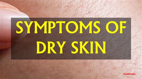 Signs You Have Dry Skin